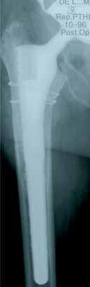 Revision via the endofemoral route: proximal fixation with endomedullary bone graft and cerclage of the