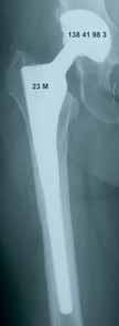 Results after 5 years and 9 months: moderate atrophy of the proximal femur but no significant modification of