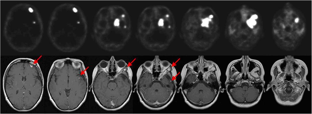 Combs et al. Radiation Oncology 2012, 7:226 Page 6 of 9 Figure 2 Multilocular relapse of a skull base meningioma 9 years after surgery in a 46-year old woman.