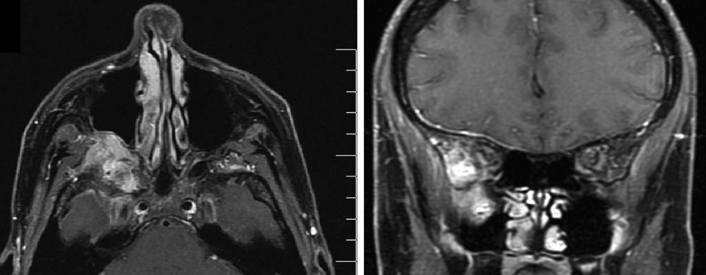 follow-up MRI showing no growth.