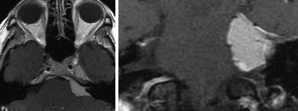 Figure 2 (A) Left petroclival meningioma; (B)