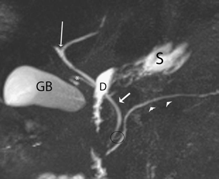 Insights Imaging (2012) 3:11 21 13 Fig. 2 Normal anatomy on MRCP. The confluence of the right and left intrahepatic ducts to form the common hepatic duct is seen (long thin arrow).