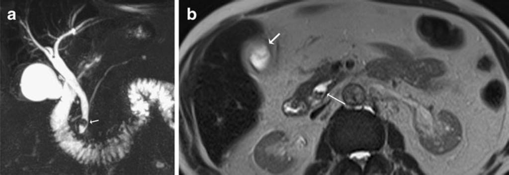 16 Insights Imaging (2012) 3:11 21 Fig. 8 a Coronal MIP reformat shows a triple confluence (*) of right anterior and posterior hepatic ducts and left hepatic duct to form the common hepatic duct.