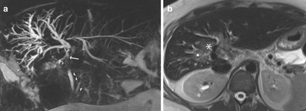 b Coronal MIP reformat in a different patient with more advanced PSC with multiple intrahepatic strictures and strictures seen in the common hepatic duct and distal CBD (arrows).