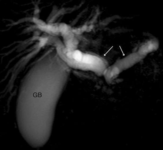 18 Insights Imaging (2012) 3:11 21 failure of fusion of the dorsal and ventral pancreatic ducts.