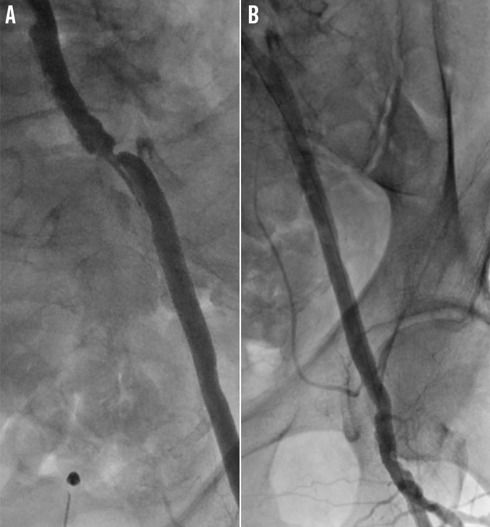 EuroIntervention 2015;11:799-807 differentiate GWs dedicated to lesion crossing from those allowing balloon and stent advancement once the lesion is crossed.