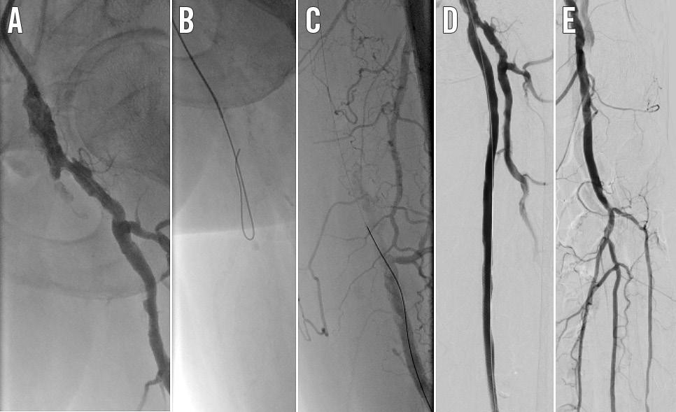 EuroIntervention 2015;11:799-807 Figure 5. Superficial femoral artery angioplasty. GB, 73-year-old male; intermittent claudication (Rutherford 3).