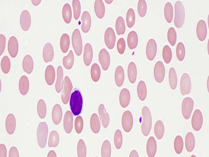 Patient #1 + cells Lymphocytes
