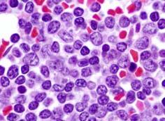 ~80-85% of lymphoblastic lymphomas Primarily, young males Most frequently presents with