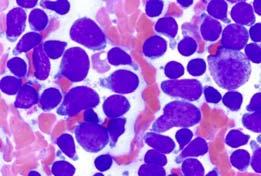 blood/bone marrow (if extensive T- ALL) Lymphoblastic Lymphoma/Leukemia Immunophenotype Most