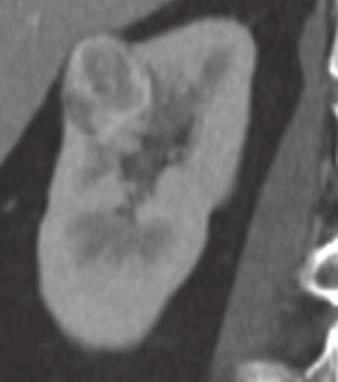 A C, Multiphasic CT image on unenhanced phase (A) shows