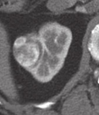 corticomedullary phase image (B) and washout on