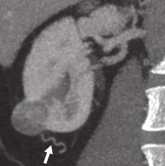 A C, Multiphasic CT image in unenhanced phase (A) shows higher density