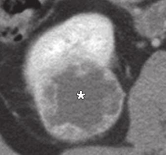 A F, CT images show specific findings including