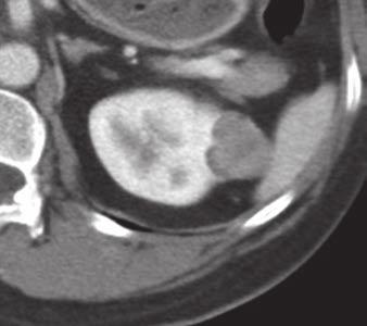 3 CT and MR images of 45-year-old woman with lipid-poor renal