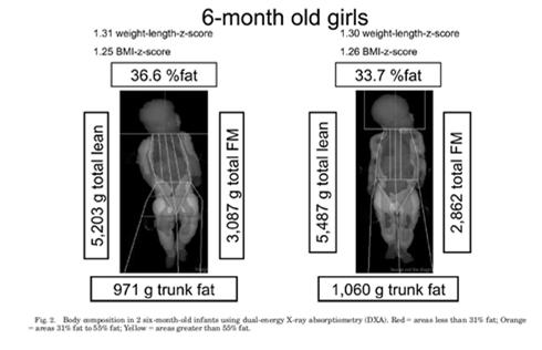 Two 6 month old girls with identical BMI but different body composition Magnetic Resonance