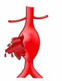 Is an aneurysm serious? If you have a large aneurysm it could be very serious.