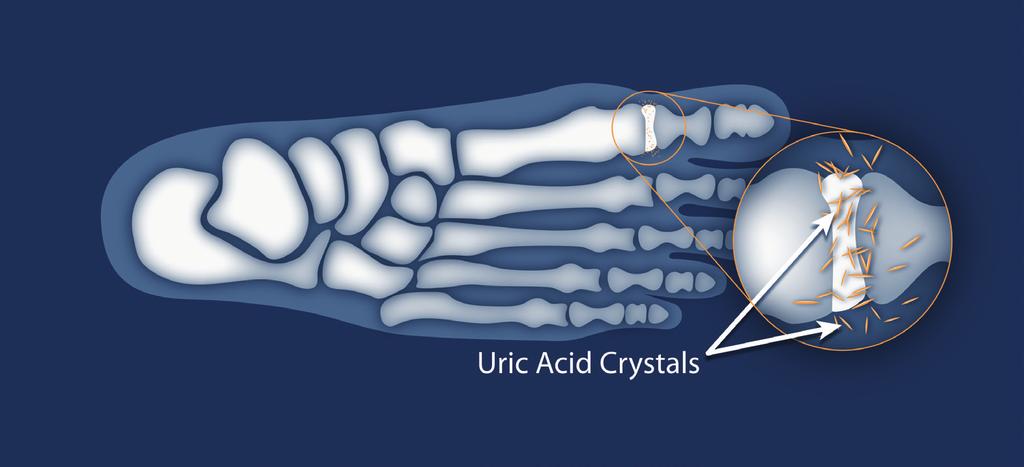 Understanding Your Condition What is gout? Gout is a form of arthritis. It causes severe pain, swelling, redness, and stiffness in the joints.