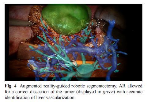 Innovative surgical approach for HCC Robotic augmented reality (AR)- assisted liver resection Fusion between live images and