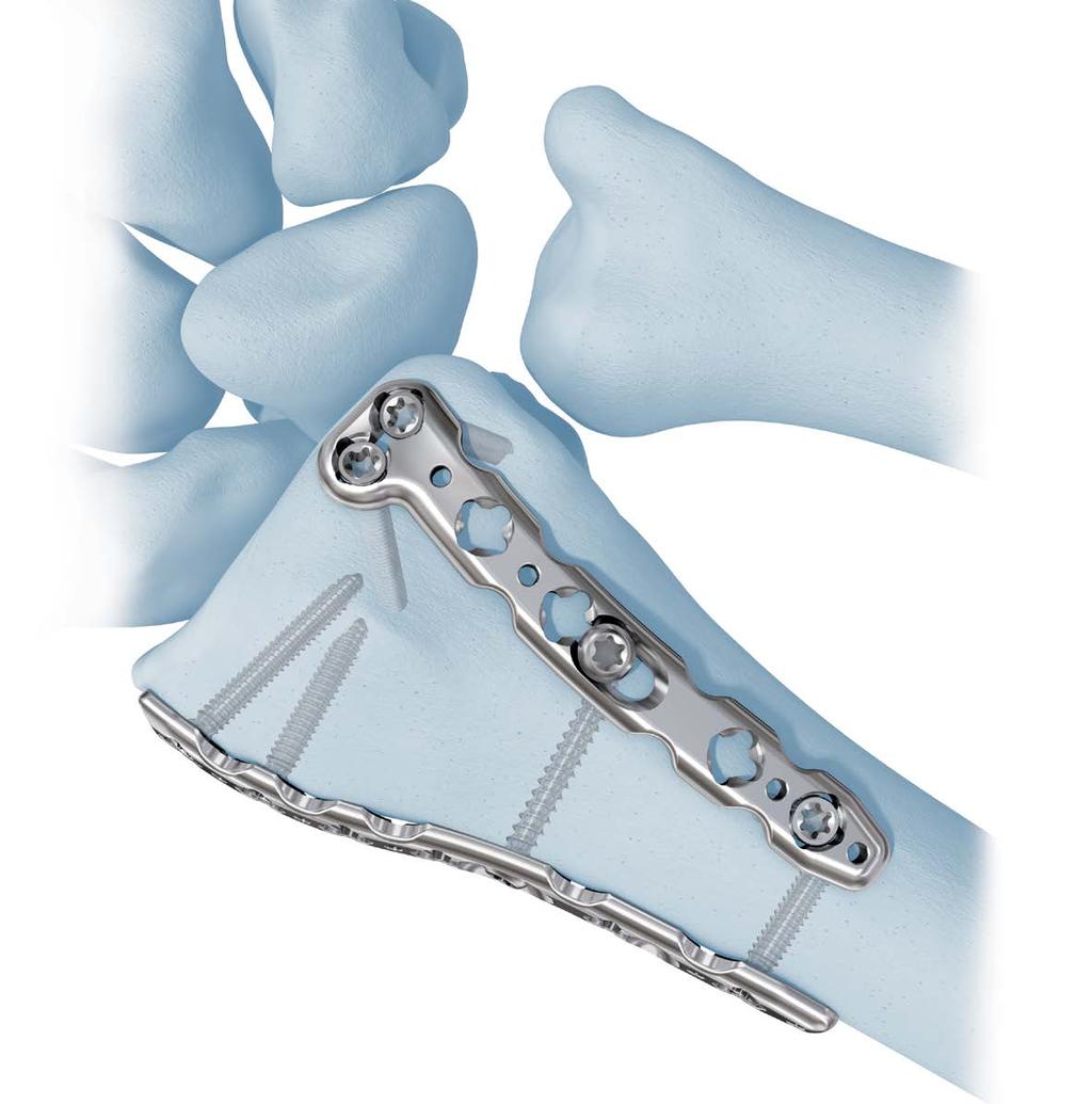 2.4 mm Variable Angle LCP Dorsal Distal Radius Plate. For fragment-specific fixation with variable angle (VA) locking technology.