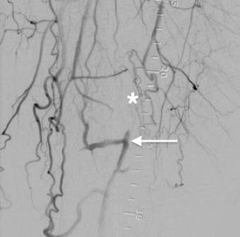 Utility of Image-Guided Atherectomy for Optimal Treatment of Ambiguous Lesions by Angiography Jon C. George, MD; Vincent Varghese, DO From the Deborah Heart and Lung Center, Browns Mills, New Jersey.