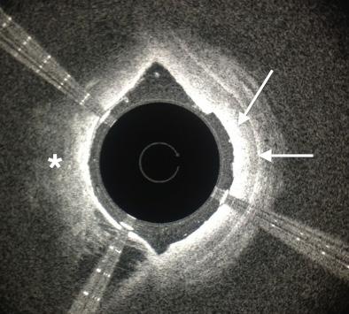 Figure 2. Optical coherency tomography imaging guided crossing of the occlusion using the Ocelot device (Avinger Inc.
