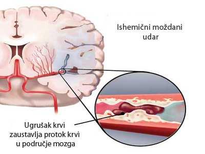 Slika 7. Ishemični moždani udar (www.plivazdravlje.hr) Slika 8A.