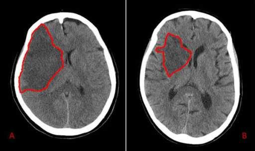2. HEMORAGIJSKI MOŽDANI UDAR Hemoragijski moždani udar podrazumijeva nakupljanje krvi unutar moždanog tkiva ili u