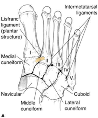Introduction Lisfranc Fractures/D islocations are part of a wide and poorly described spectrum of injuries.