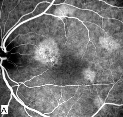findings in a case of 38 years old male suffering from CSC in the left eye with mid phase