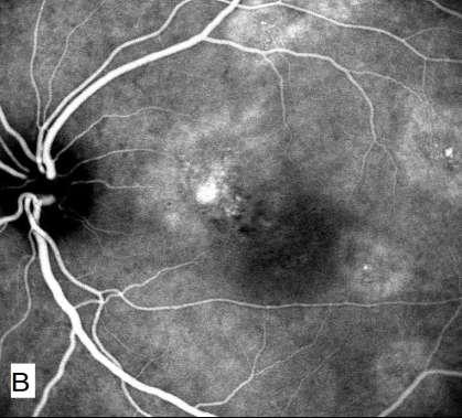 Figure 3 (B) - ICGA findings in a case of 38 years old male suffering from CSC in the left eye showing patchy
