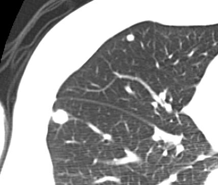 MR Lung: Pulmonary