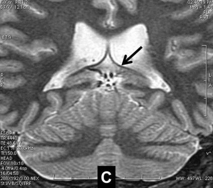 Refractory focal epilepsy: findings by MRI. high costs this represents for the health system (2, 3).