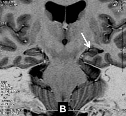 The objective of our work is to carry out an iconographic trial with the findings by MRI in a group of patients with refractory epilepsy, systematizing and organizing hierarchically the most frequent