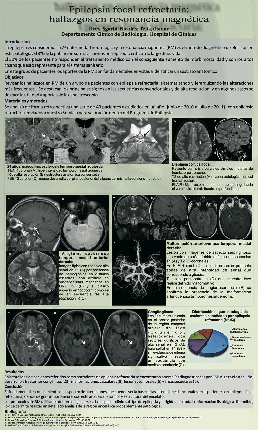 Refractory focal epilepsy: findings by MRI.