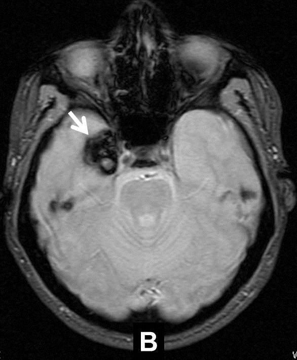 and in 2 cases it was gangliogliomas. Of the total lesions in this group, 4 were of temporal localization. (Figure 4). perinatal background related to the lesion found.