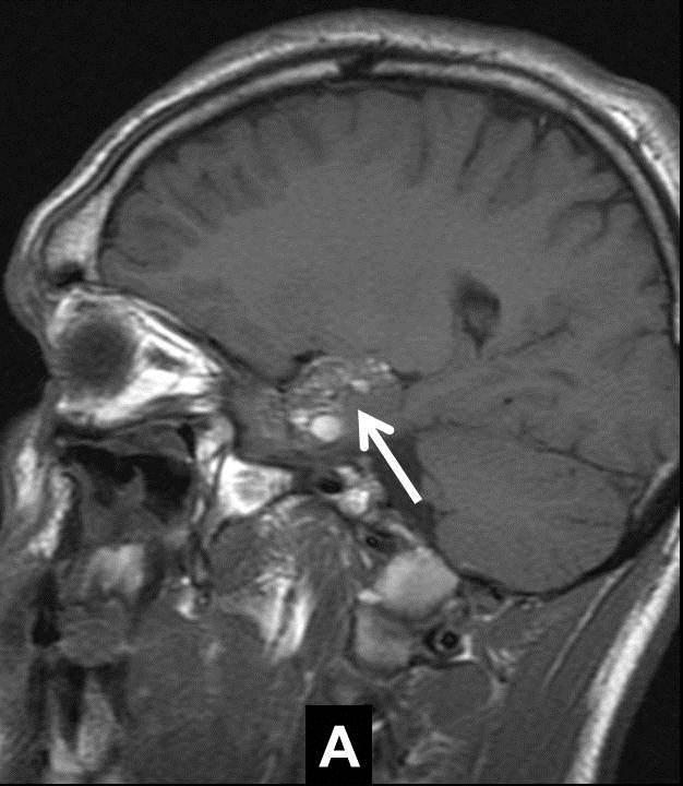 The remaining patient presented epilepsy which had started recently and 6 months of evolution, refractory to all established medical treatment and which showed a large pathological area Figure 3: