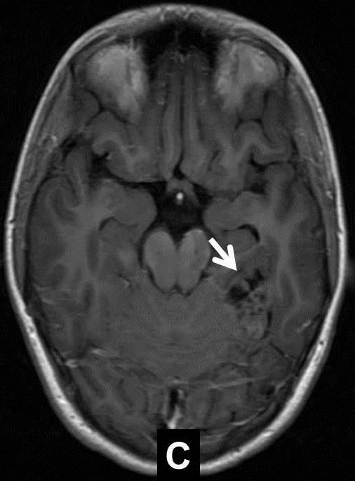 Refractory focal epilepsy: findings by MRI. Figure 4: Ganglioglioma.