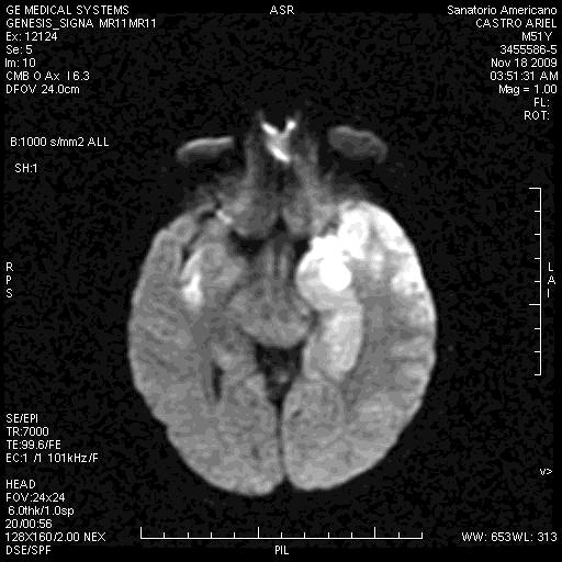 A point to highlight in this small series is that all the patients referred as bearers of refractory epilepsy presented anomalies diagnosed by MRI, there weren t no cases of negative MRI and other