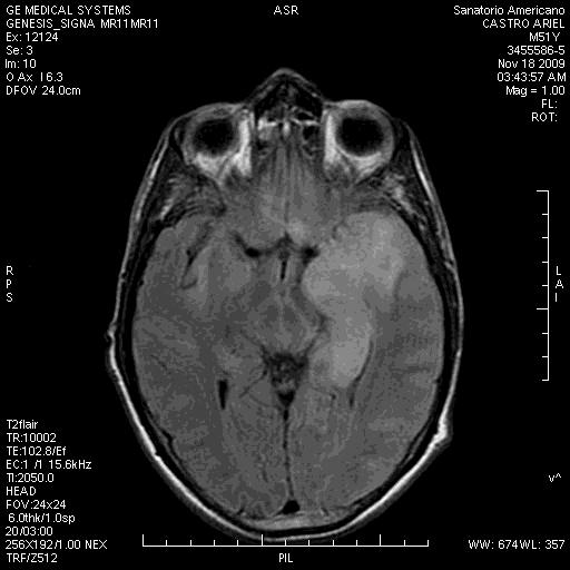 It is vital to know the wide spectrum of alterations, which can be the cause of functional alterations in the patient with refractory focal epilepsy, correct anatomic and structural analysis of the