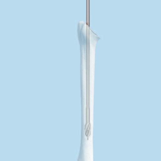 Implantation of Long- or Extra-Long Stem 1 Preparation Required sets 01.401.003 Epoca Shoulder Prothesis Trial Implants Instrument Set 150.