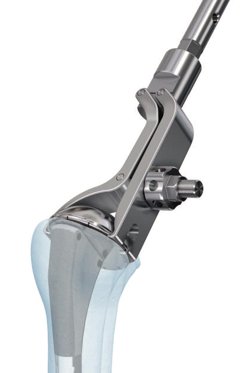 The Epoca Revision Instrument Set provides instrumentation for extraction and revision of Epoca shoulder
