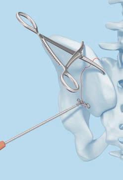 To reduce the posterior iliac fragment, insert a temporary screw into the posterior superior iliac spine. (2) Compress the fracture using the bone holding forceps.
