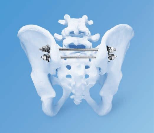 Other Available Pelvic Instruments and Implants from Synthes Sacral Bars The Synthes 6.0 mm Threaded Sacral Bars offer an additional option for stabilization of the posterior pelvic ring.
