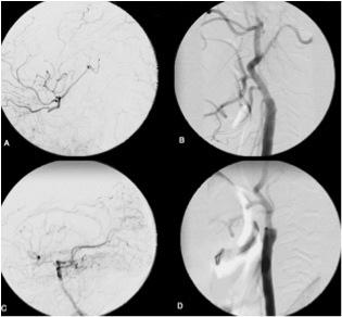side. Fig. 1. Initial cerebral MRI showing multiples old infarcts in both hemisphere Carotid angiograms demonstrated bilateral ICA occlusion at the level of common carotid artery bifurcation (Fig. 2).