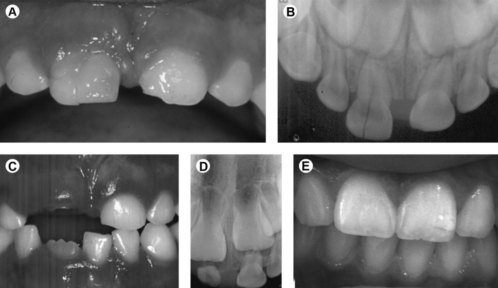 V.P.P. Costa et al. Figure 1. Crown-root fracture in maxillary right central primary incisor.