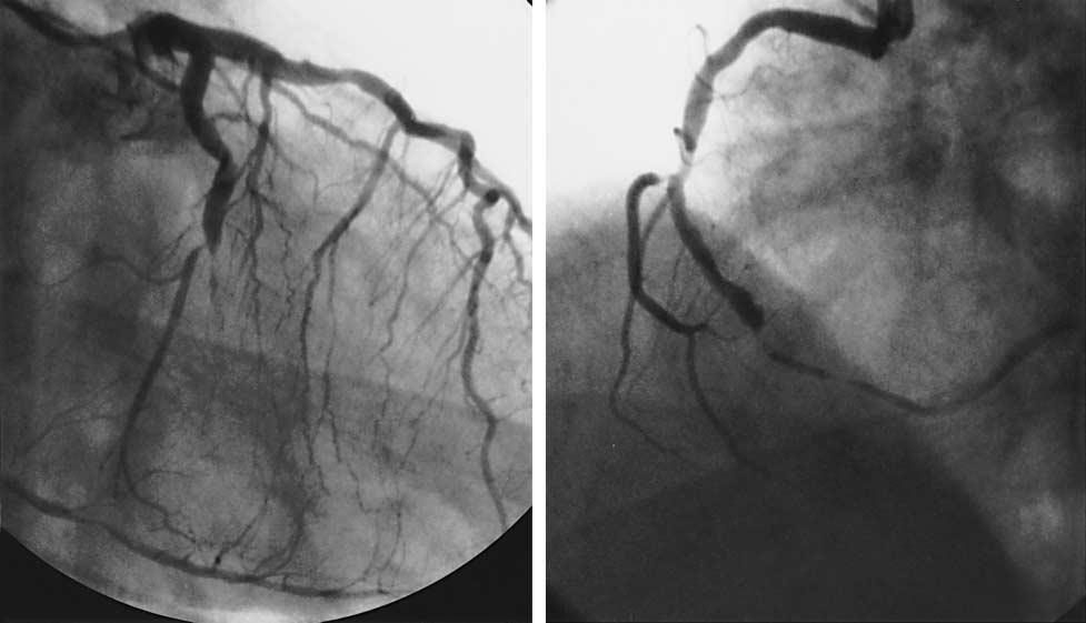 Figure 2. Angiograms from a Patient with Acute Inferior Posterior Myocardial Infarction.