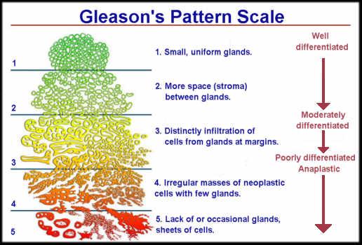 Gleason Scores Pathologic diagnosis by Gleason