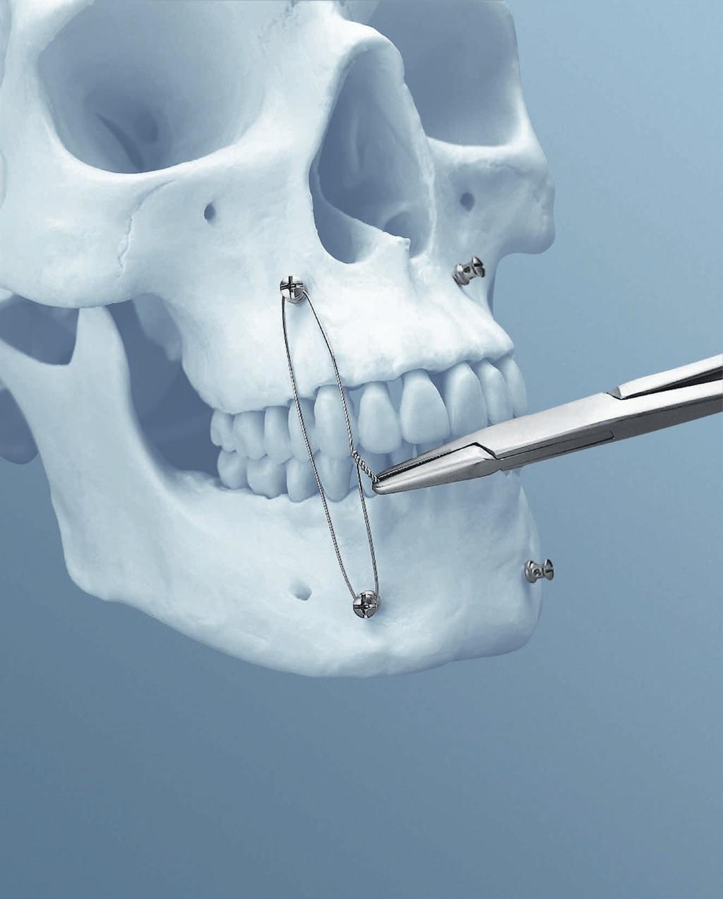 IMF Screw Set. For temporary, peri opera tive stabilisation of the occlusion in adults.