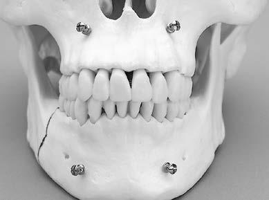 5 Insert additional screws Repeat the procedure by inserting at least two additional screws on the contralateral side, one in the maxilla and one in the mandible following the